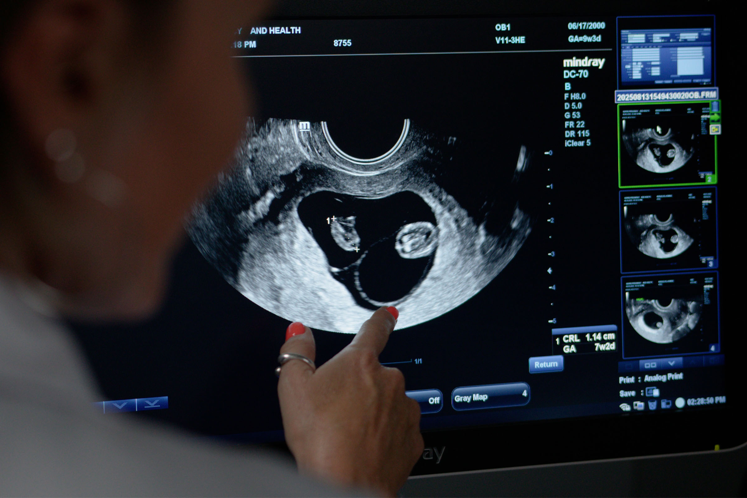 A doctor examines an ultrasound image on a monitor